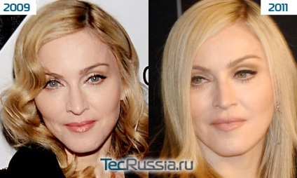 Madonna - fotók előtt és után plasztikai sebészet