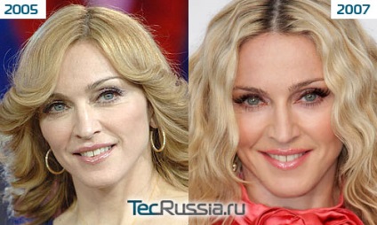 Madonna - fotók előtt és után plasztikai sebészet