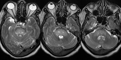 MRI a pályán és az optikai idegeket, ami megmutatja az ár, vélemények, fotók