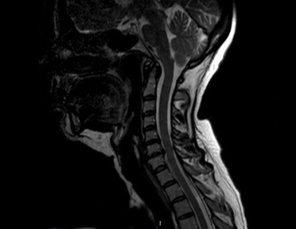 MRI a lágy szövetek, a nyak, amely megmutatja, hogyan mennek a dolgok a nyaki gerinc