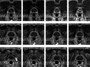 MRI a prosztata, a képalkotó prosztata adenoma