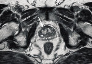 Prosztata hiperplázia MRI)