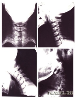 MRI a nyaki gerinc és a nyak hajók, mellkasi, ágyéki