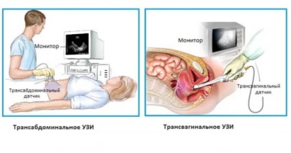 Mely napon a ciklus csinálni kismedencei ultrahang petefészek ciszta ultrahanggal