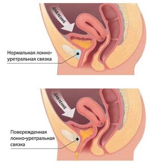 A vizelet inkontinencia - okok, tünetek és a kezelés