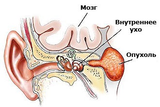 Akusztikus neurinoma - tünetek és kezelés akusztikus betegség