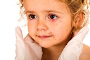 Szövődmények a bárányhimlőből gyermekeknél és felnőtteknél (bárányhimlő) Szövődmények a bárányhimlőből gyermekeknél és felnőtteknél