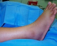 A láb és a boka ízületének duzzanata, Első teendő lábdagadás esetén