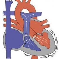 Nyitott foramen ovale, a szívében egy gyermek - egy szikét - Orvosi Információs és Oktatási