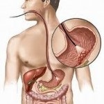 Poison eceteszencia (mérgezés mérgezés ecetsav eceteszencia pár elsősegély kezelési hatások) Poison eceteszencia