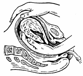 Abruptio placenta és izolálása bonyolult sorozat periódusának, szülészet