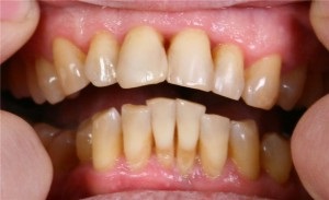 A periodontitis - okai, tünetei és népi jogorvoslati paradentózisnál