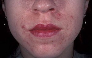 Száj körüli bőrgyulladás az arcon az okok, tünetek, kezelés, sprosidermatologa