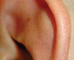 Perichondrium a fül tünetek, fotó, kezelés