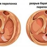 Perichondrium a fül tünetek, fotó, kezelés