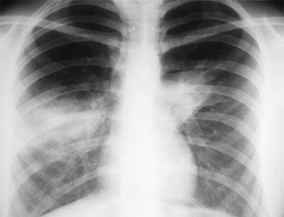 Tüdőgyulladás kép tüdőgyulladás (pneumonia) Tüdőgyulladás felvételek tüdőgyulladás