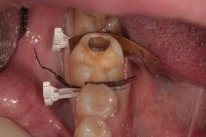 Miért fogfájás után fogszuvasodás kezelés