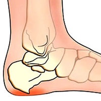 Field receptek, calcaneus homlok (mező receptek) Field receptek, sarok homlok