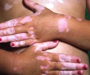 Készítmények kezelésére vitiligo és jellemzőik