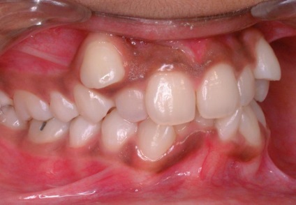 Okai fogszuvasodás - az, hogy mi történik a fogszuvasodást