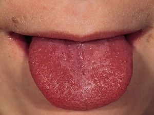 Pattanások a nyelv a gyermek - kis fehér pattanások okoz akne és fotó