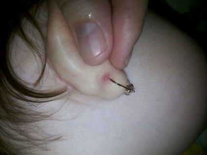 Pattanás a fül lebeny az okai és a kezelés