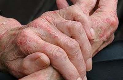 Psoriasis a kéz, mint kezelni, amit a tünetei és okai