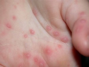 A sugárkezelés okozta bőrgyulladás kezelése