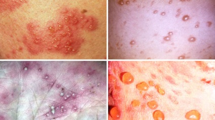 Hólyagos bőrgyulladás - okai, tünetei és kezelése (fotó)