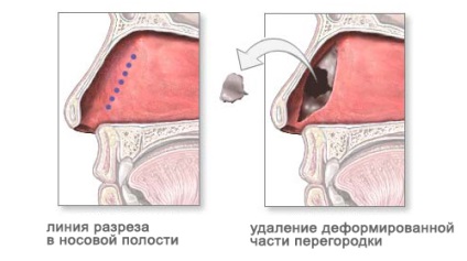 Septoplasty (septoplasty) - az ár előtt és után, a beteg véleménye
