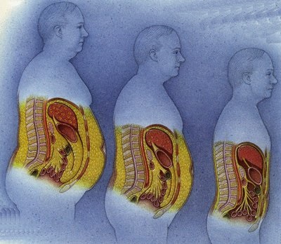 Симптоми опущення шлунка і кишечника, ознаки та лікування гастроптоза