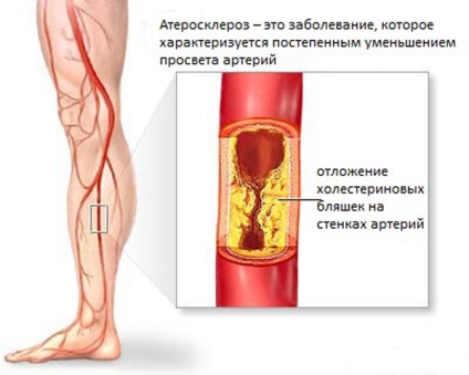 Sclerosis az alsó végtagok (lábak) - tünetei, kezelése népi jogorvoslat és gyógyszerek