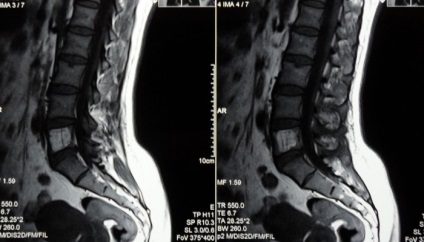 Spinalis stenosis ágyéki és nyaki gerinc (stenosis) Gerincszűkület ágyéki és a nyaki gerinc