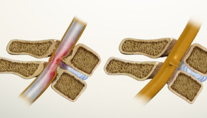Spinalis stenosis ágyéki és nyaki gerinc (csatorna) Gerincszűkület ágyéki és a nyaki gerinc