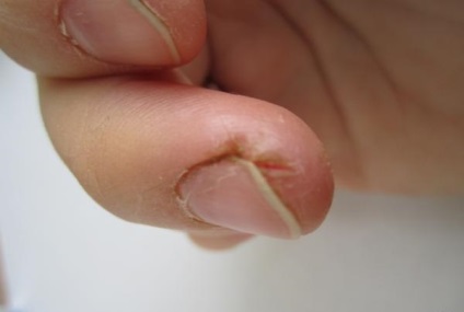 repedések az ujjai alsó kezelés cukorbetegség