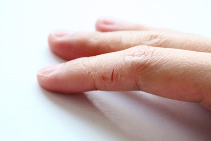 Repedések az ujjak okoz és kezelések