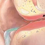 Petevezeték középfülgyulladás - mi ez, tünetei és kezelése tubootitis