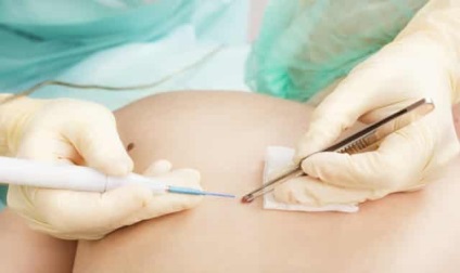 Eltávolítása melanoma - minden, amit tudni kell a műveletet (szükséges) Eltávolítása melanoma - minden, amit tudni kell a műveletet