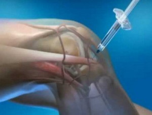 Injekciót a közös arthrosis