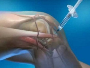 Injekciót a közös arthrosis (injekció) Injekciót a közös arthrosis