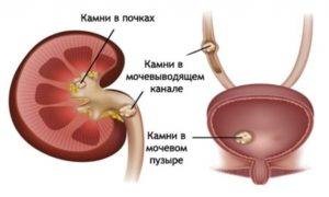 Urolithiasis férfiak, a tünetek a vesekő betegség kezelésére urolithiasis férfiak