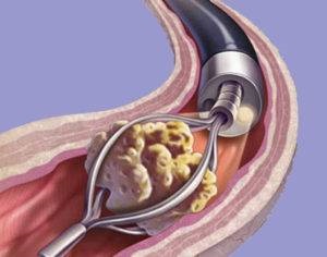 Urolithiasis férfiak, a tünetek a vesekő betegség kezelésére urolithiasis férfiak