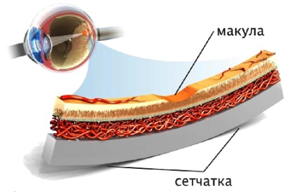 A sikeres kezelés nedves makula degeneráció a retina látás helyreállításához klinikára unikamed