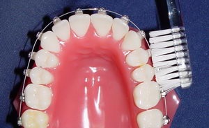 Gondozó a fogakat fogszabályozó - szabályokat és ajánlásokat a beteg - körülbelül harapás korrekciója és fogszabályozó