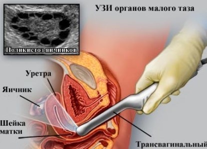 Ultrahang a petefészkét normál méretű, mint ahogy a (kismedencei) Ultrahang a petefészkek a normál méret, a do