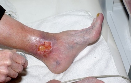 Visszeres dermatitis az alsó végtagok, a kezelés, a tünetek, hogyan kell kezelni