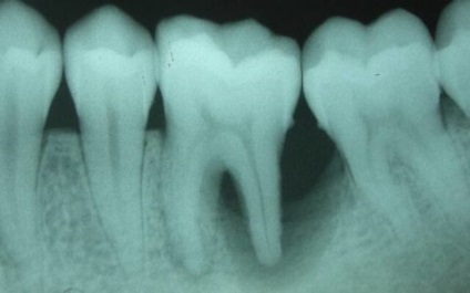 Gyulladás a fogíny fogak közötti választhat a hatékony kezeléshez