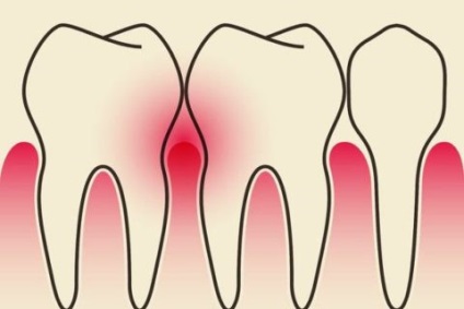 Gyulladás a fogíny fogak közötti választhat a hatékony kezeléshez