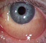 Chemosis a kötőhártya - a leghatékonyabb kezelések, tapasztalt orvosok, a legjobb feltételek és árak - (kötőhártya) Chemosis a kötőhártya - a leghatékonyabb kezelések, tapasztalt orvosok, a legjobb feltételek és árak -
