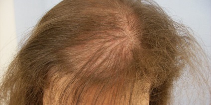 Bras alopecia okait és kopaszság kezelésére hatékony eszközöket